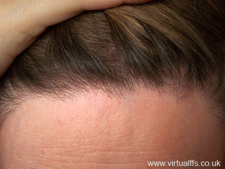 Virtual Ffs Hair And Hairline