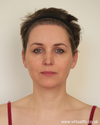 Virtual FFS - frontal AFTER